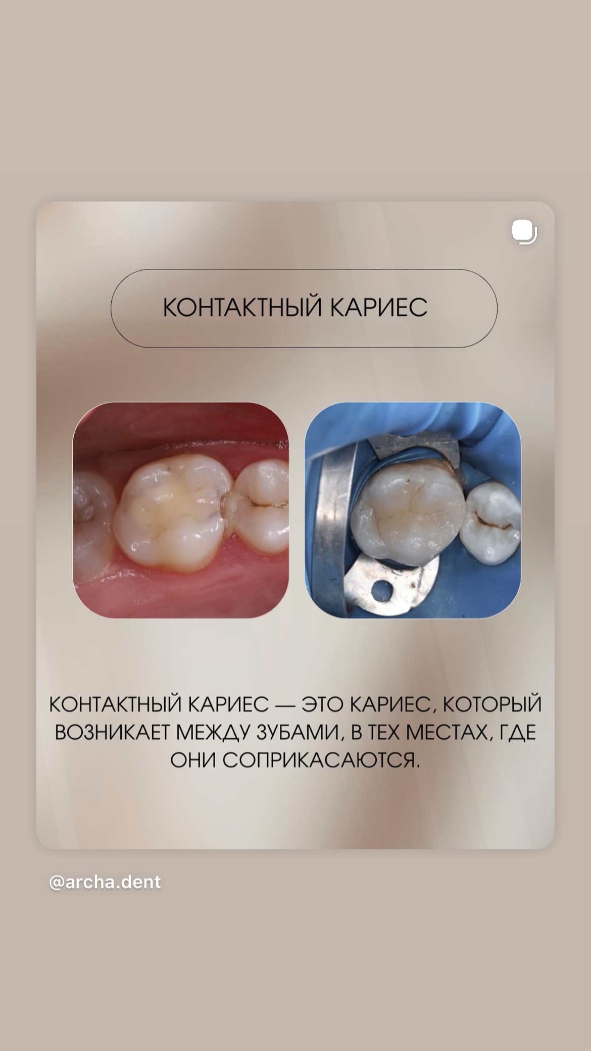 Archa Dent процедура