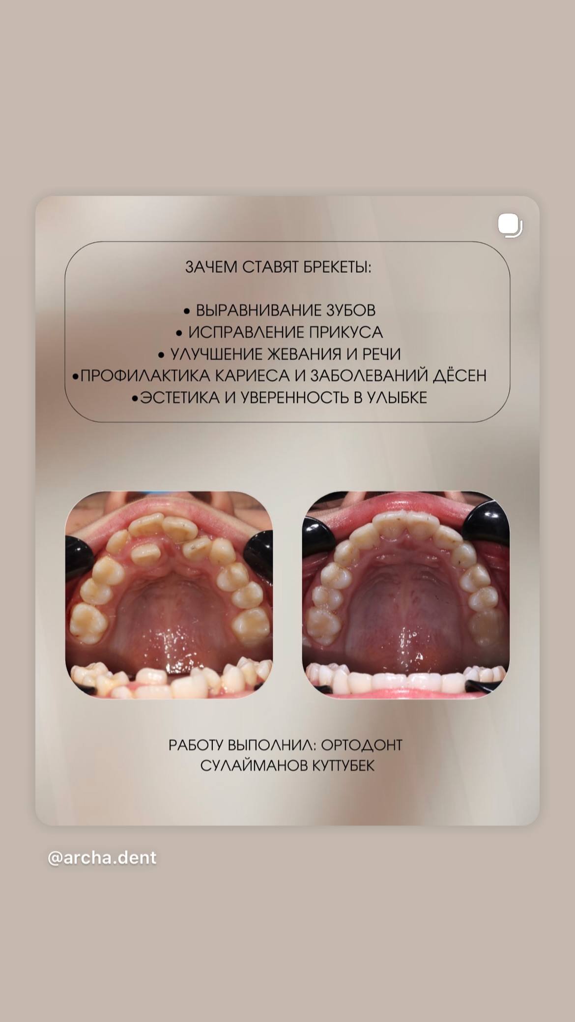 Брекеты Archa Dent
