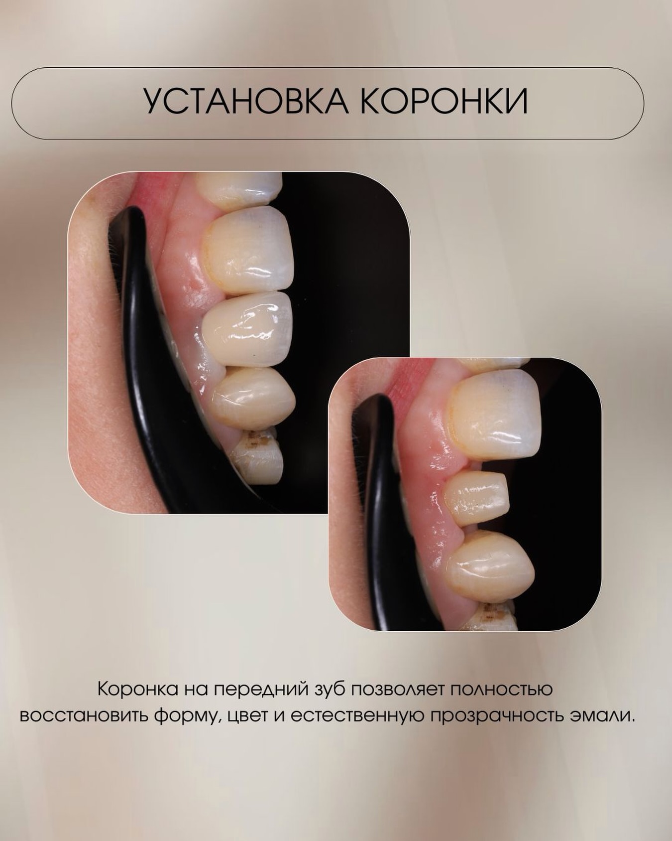 Коронки металлокерамика цирконий