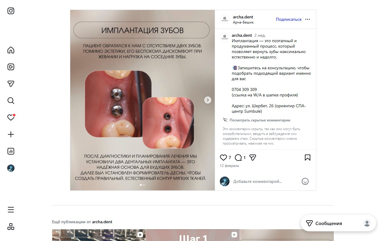 Имплантация зубов